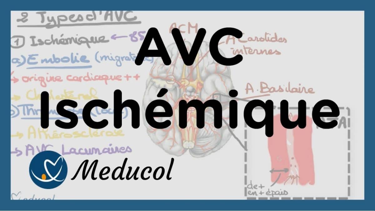 Les causes, les signes et voies de traitement des AVC ischémiques et hémorragiques !